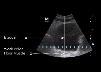 An ultrasound scan showing weak pelvic floor before EMSELLA chair treatment.