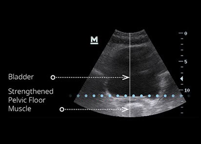An ultrasound scan showing visual change in the pelvic floor muscle after EMSELLA chair treatment.